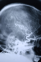 Boston Brain Injury Litigation